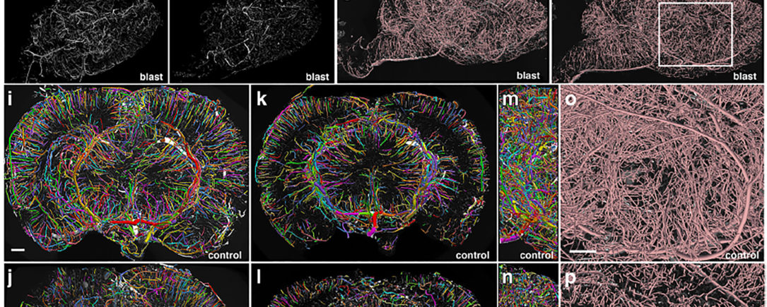 BriteVu used to study Traumatic Brain Injury