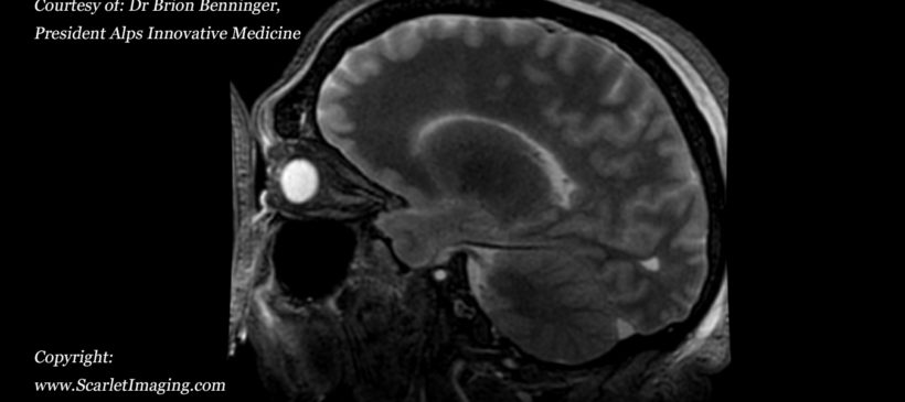 BriteVu contrast agent perfused human cadaver brain