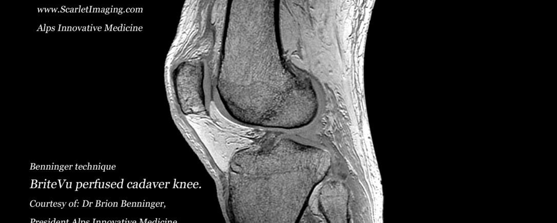 New technique to visualize the human knee using BriteVu and MRI
