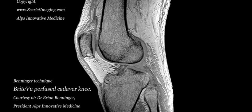 New technique to visualize the human knee using BriteVu and MRI