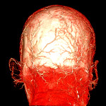 A human cadaver head perfused using BriteVu.  