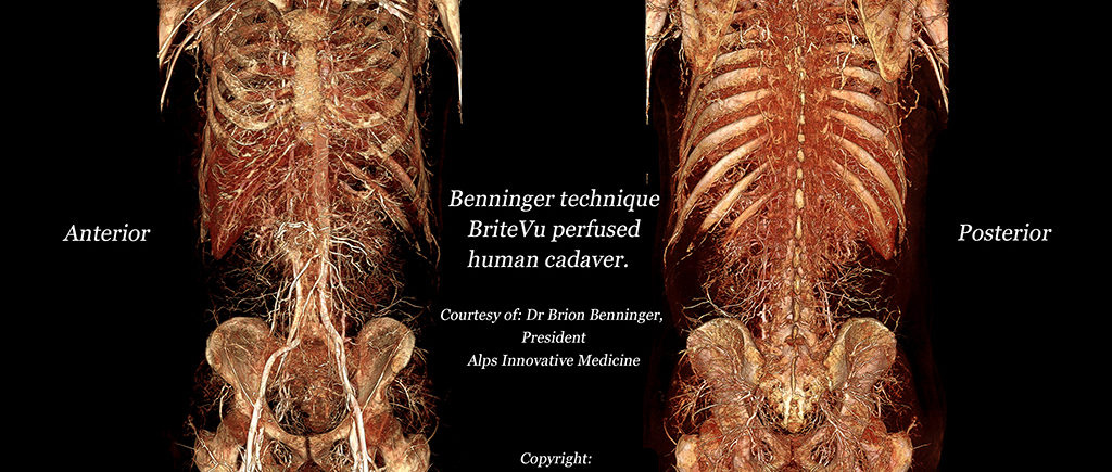 BriteVu perfused whole human cadaver!!!