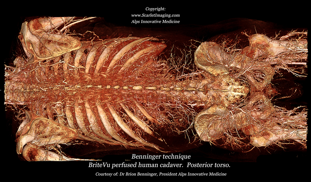 Human cadaver with BriteVu