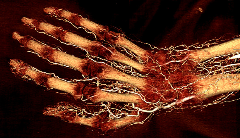 Human hand perfused with BriteVu contrast agent