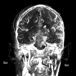 A human cadaver head perfused using BriteVu.  