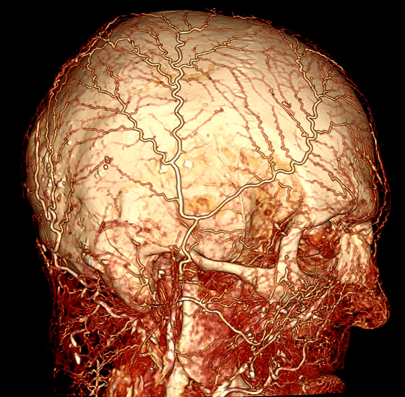 BriteVu contrast enhanced image of a human cadaver head