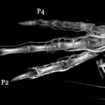 Pigeon foot (whole body) BriteVu contrast ateriovenogram.