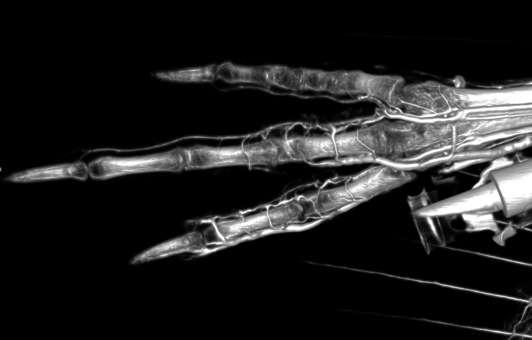 Pigeon Foot High Radiodensity Contrast Perfusion Using BriteVu
